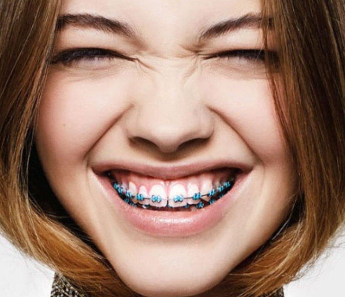 Красивые девушки с брекетами