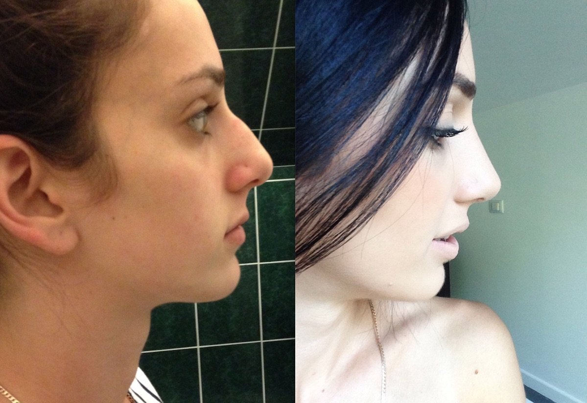 Нос с горбинкой у девушки