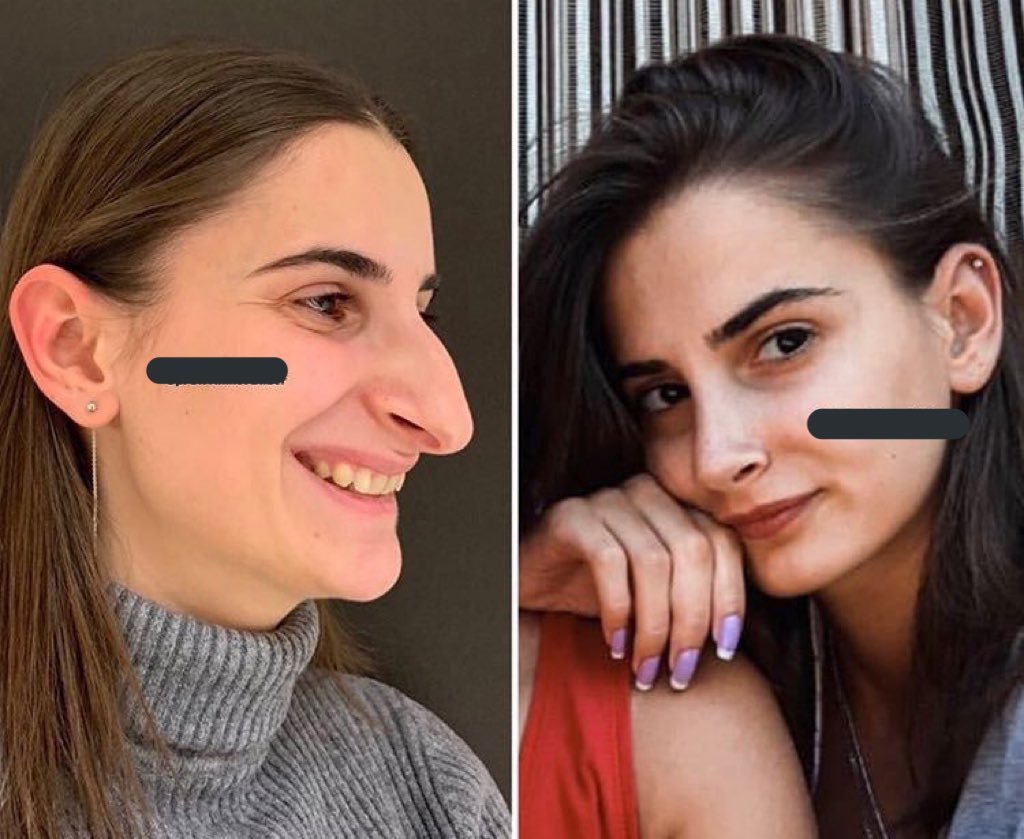 Ахмед Дилбер ринопластика