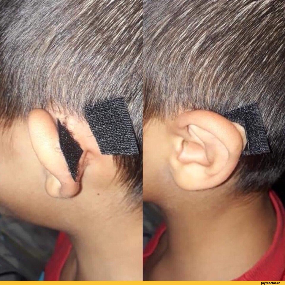 Скотч от лопоухости