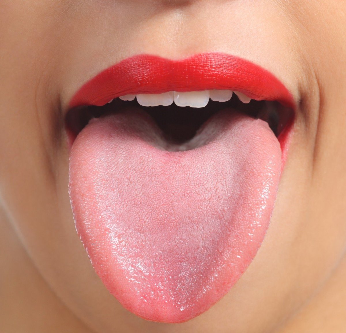 Гипопластический глоссит