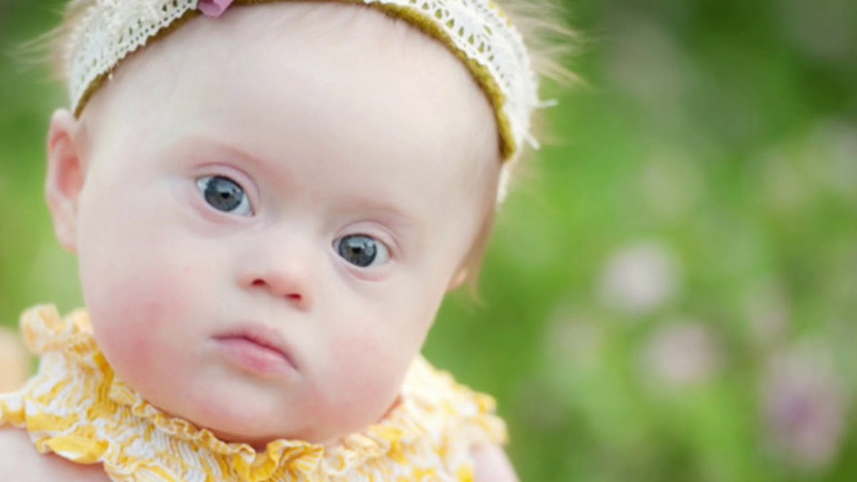 Солнечные дети дауны