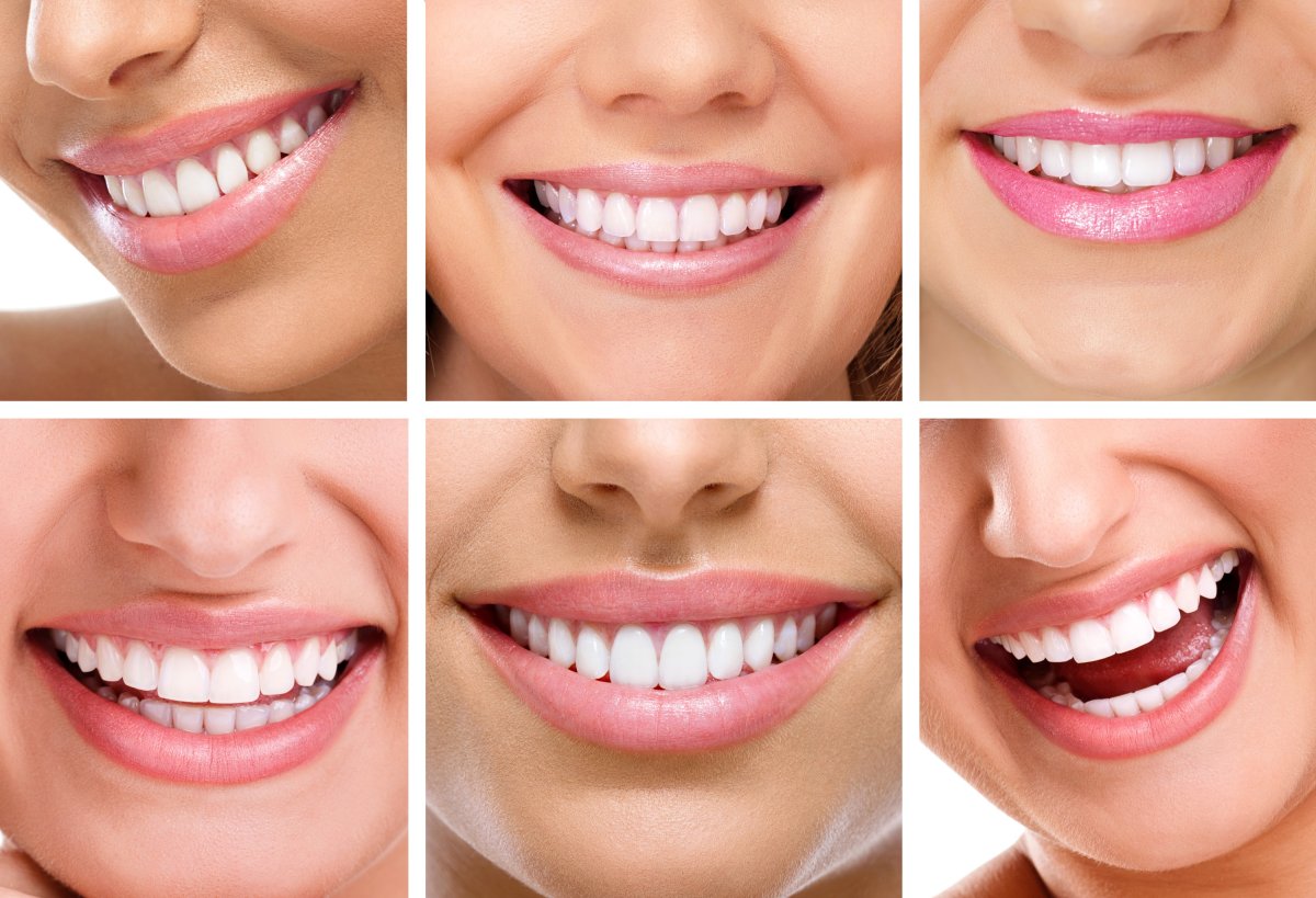 Не идеальные зубы тоже красивые