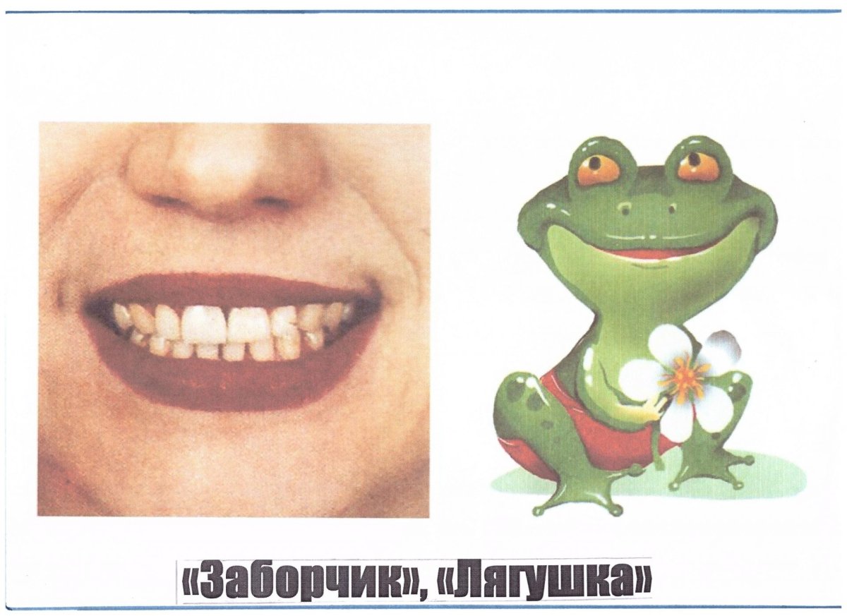 Артикуляционная гимнастика лягушка