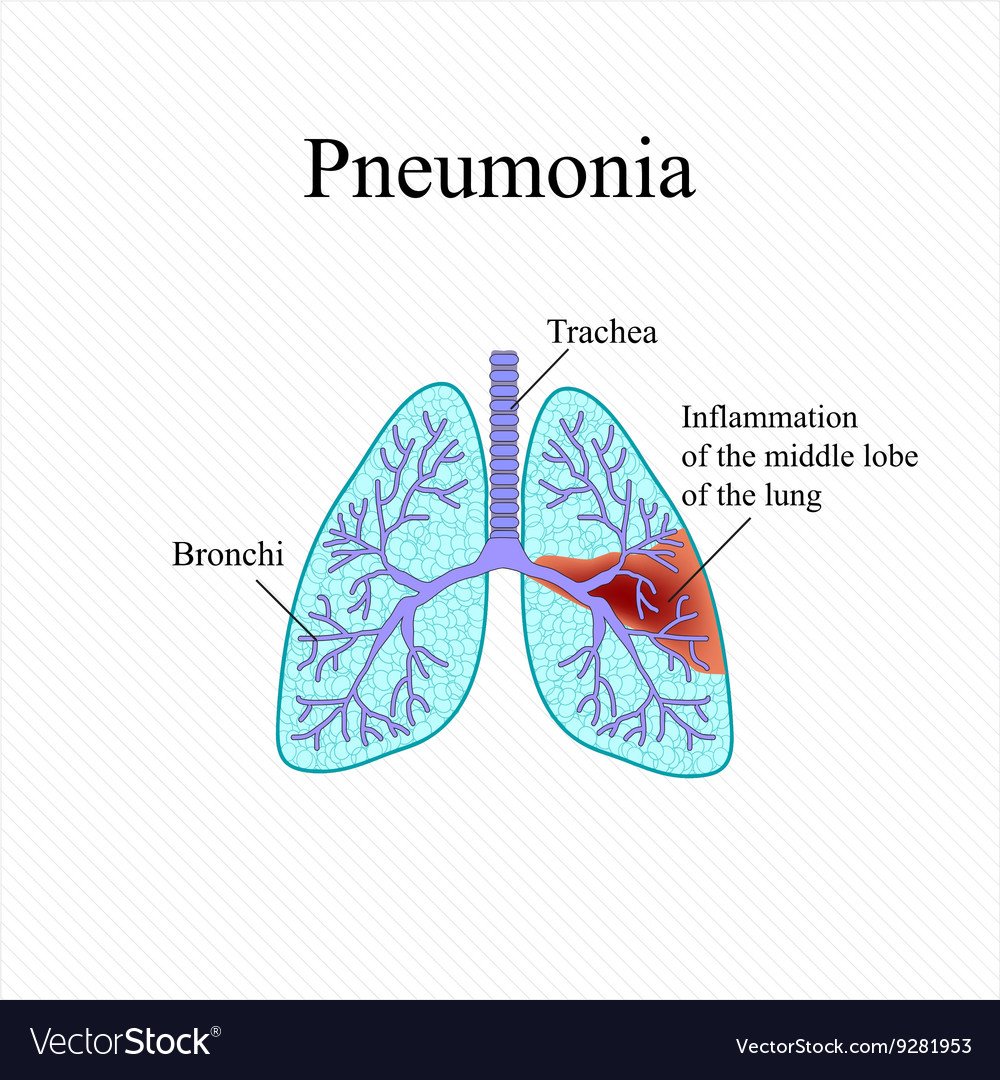 Пневмония схематично