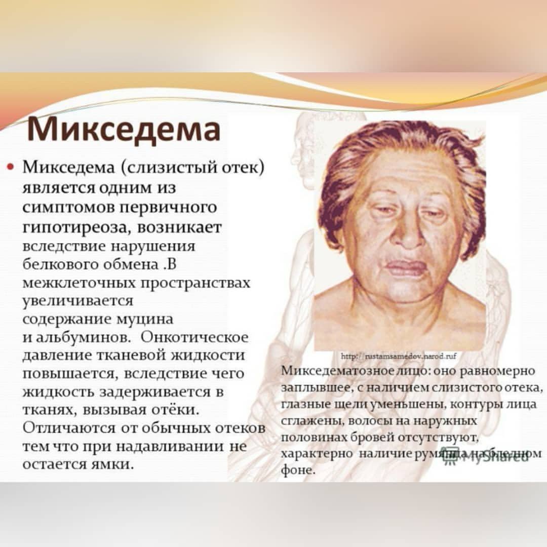 Дефицит железа симптомы
