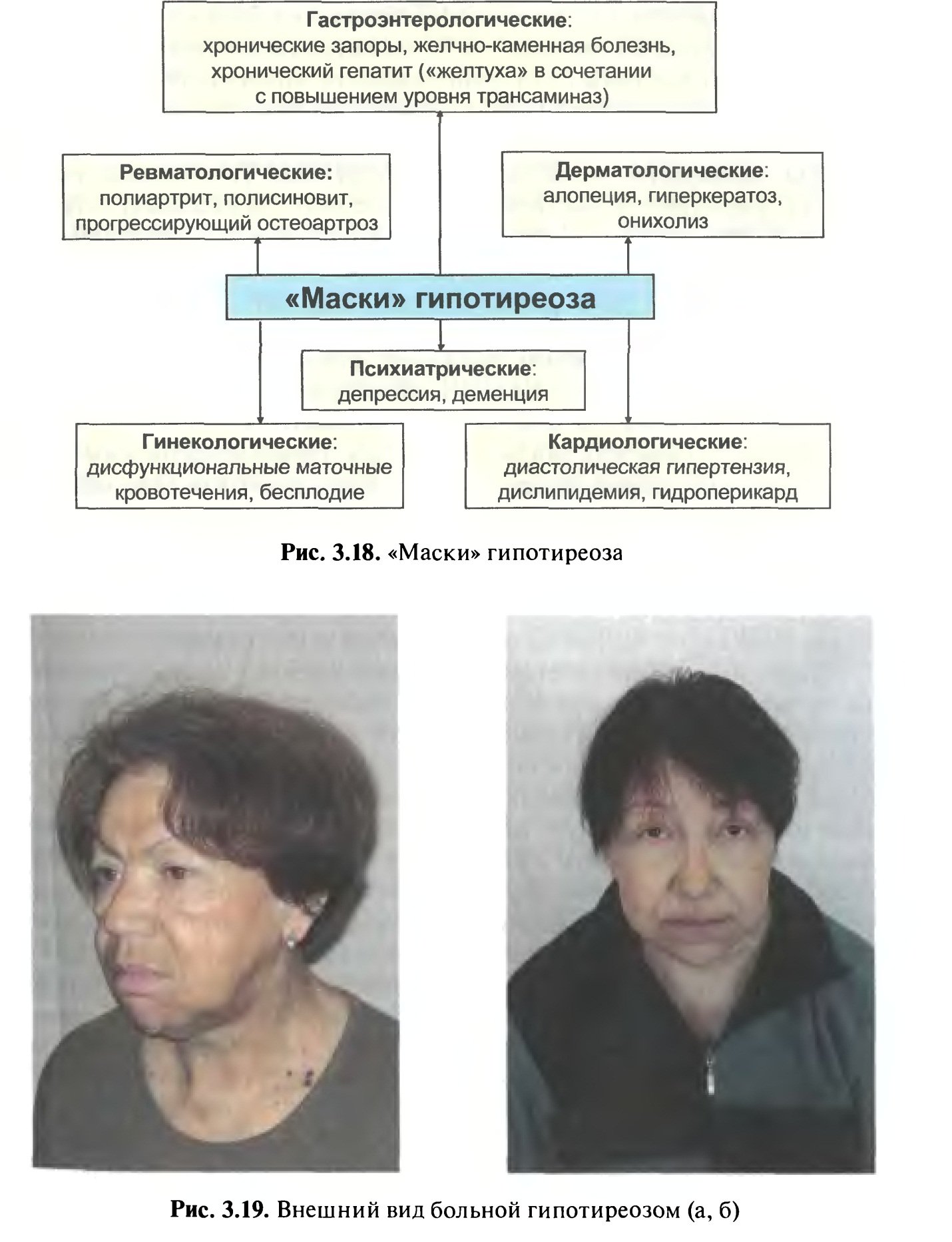 Клинические проявления гипотиреоза. Лицо женщины с гипотиреозом. Лицо пациента с гипотиреозом.