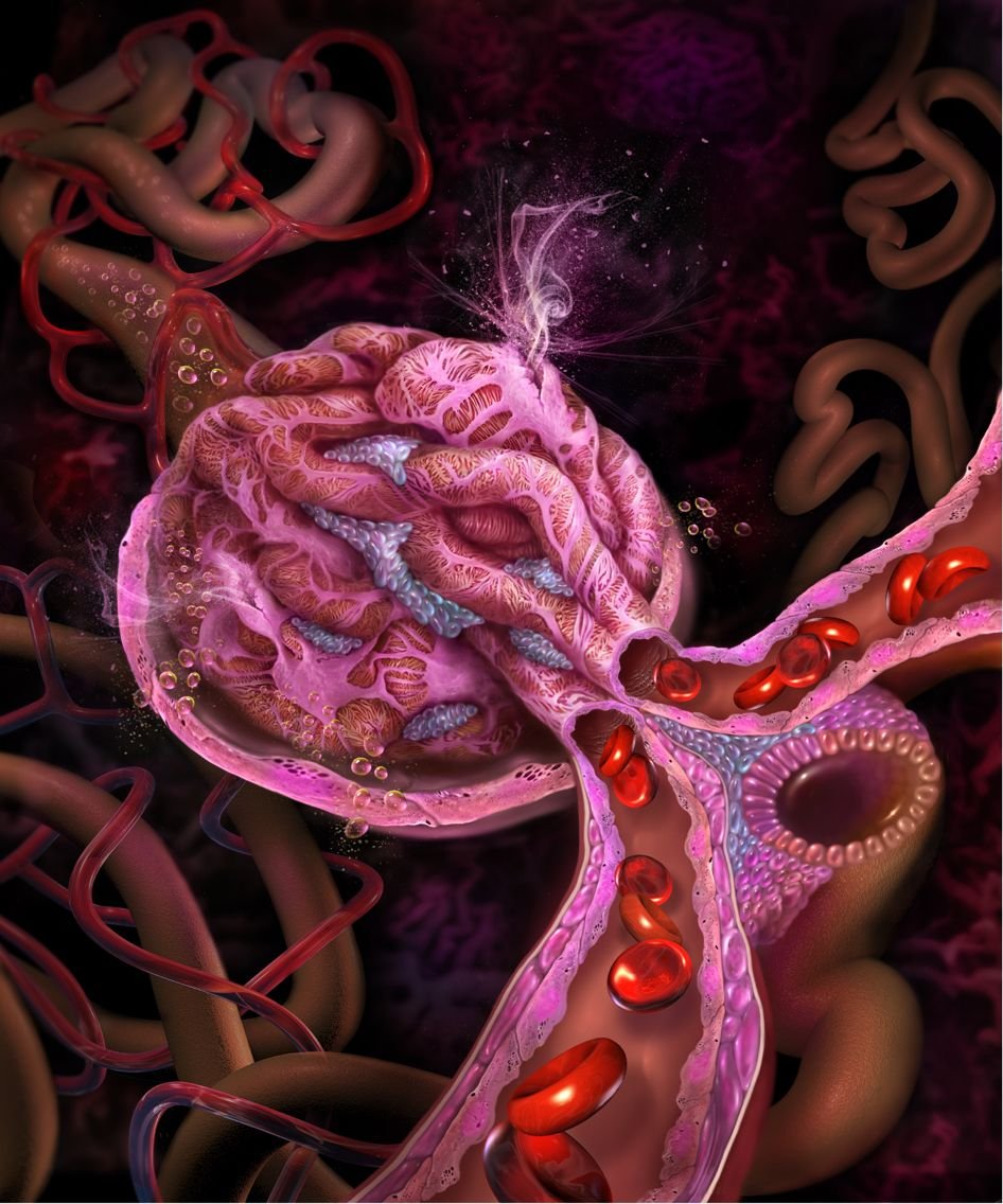 Гиперцеллюлярность клубочков