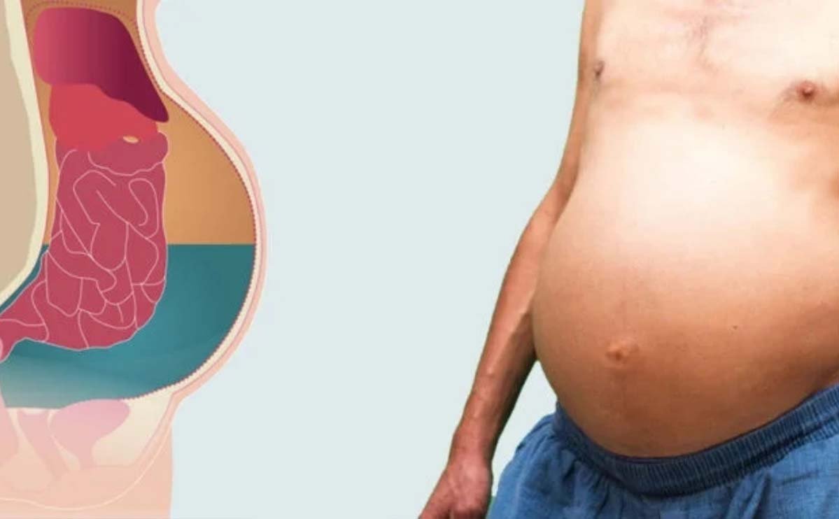 Абдоминальный парацентез