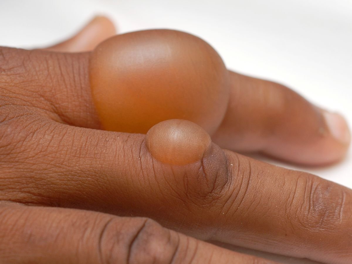 Диабетические волдыри