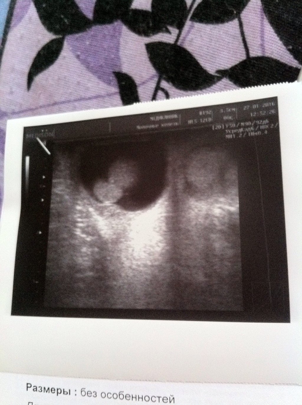 Стефани Кин анэнцефалия