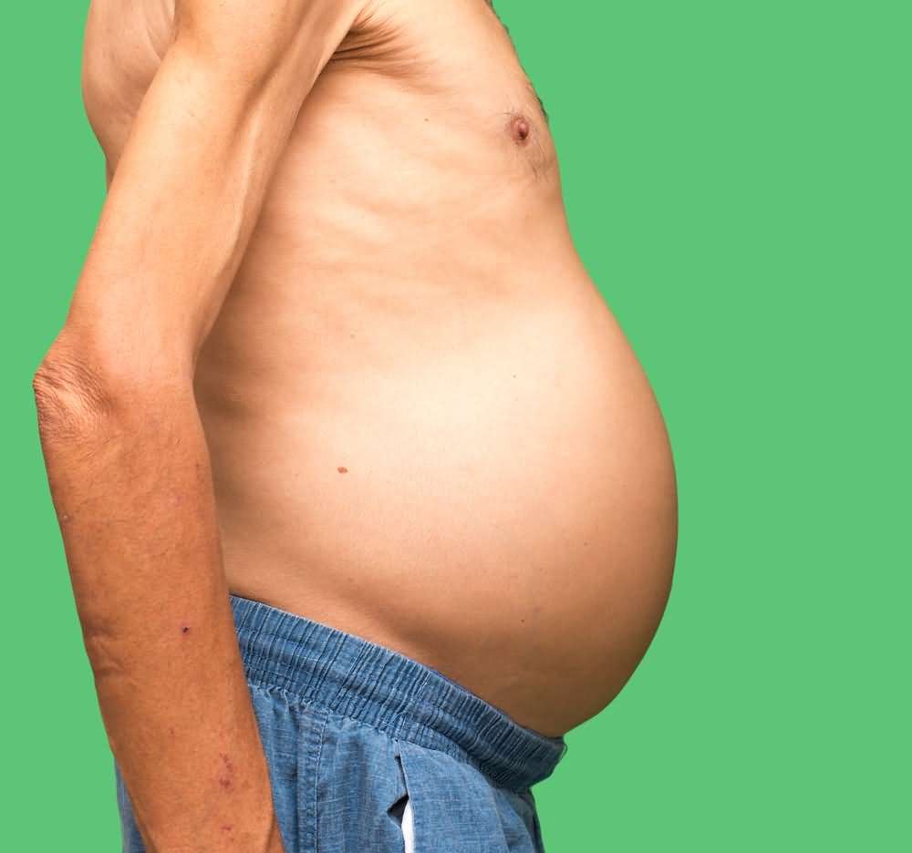 Асцит брюшной полости цирроз печени