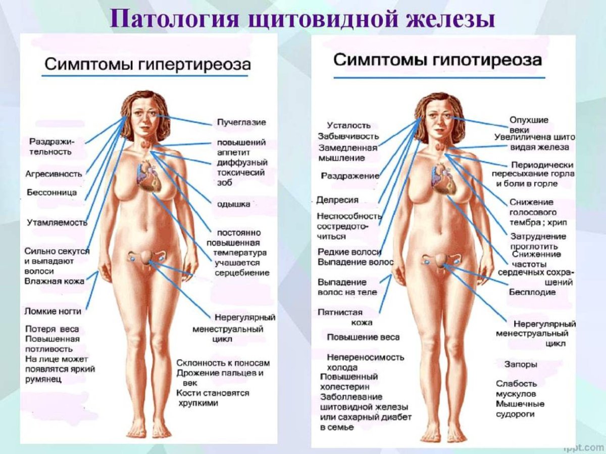 Заболевания щитовидной железы памятка