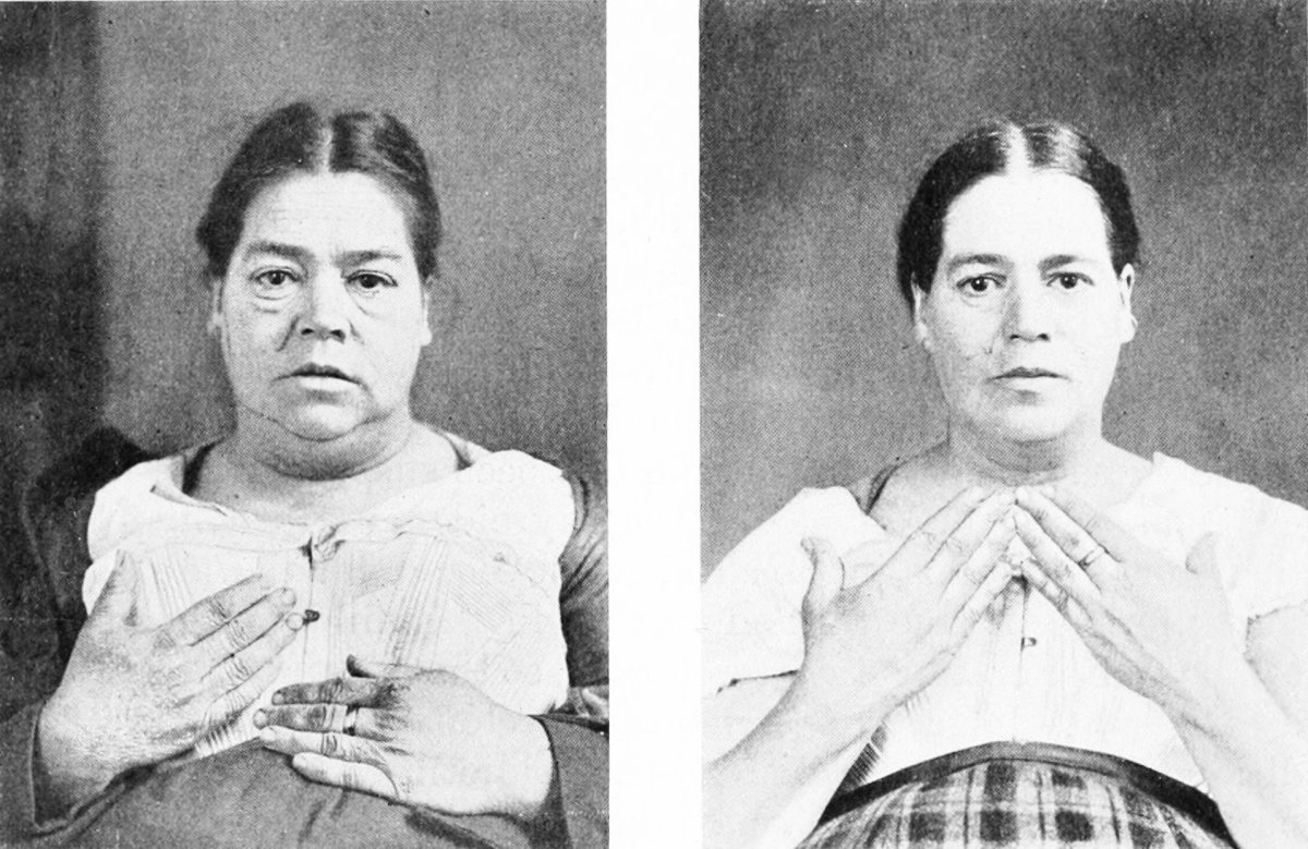 Гипотиреоз и гипертиреоз