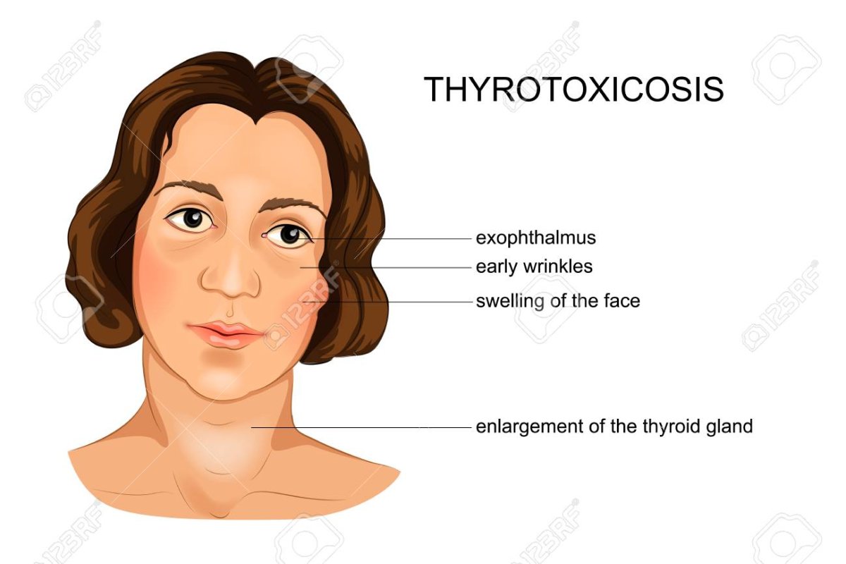 Гипотиреоз головные боли