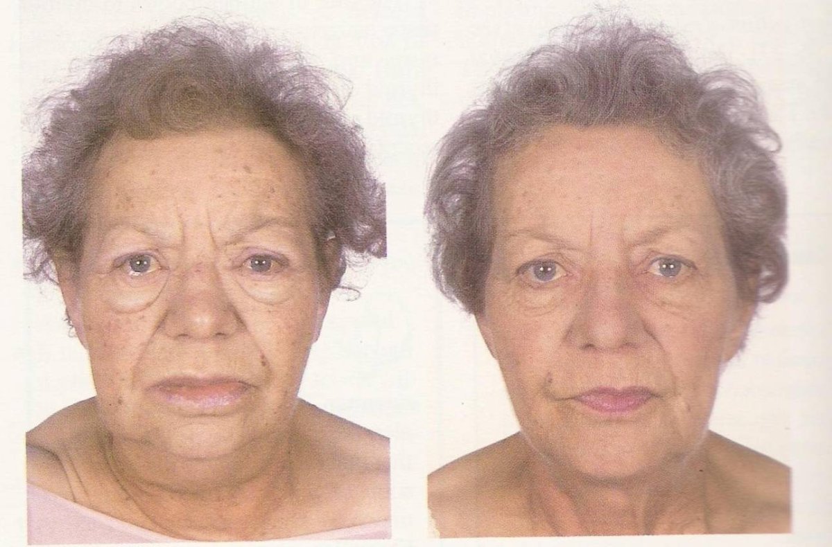 Щитовидная железа симптомы заболевания