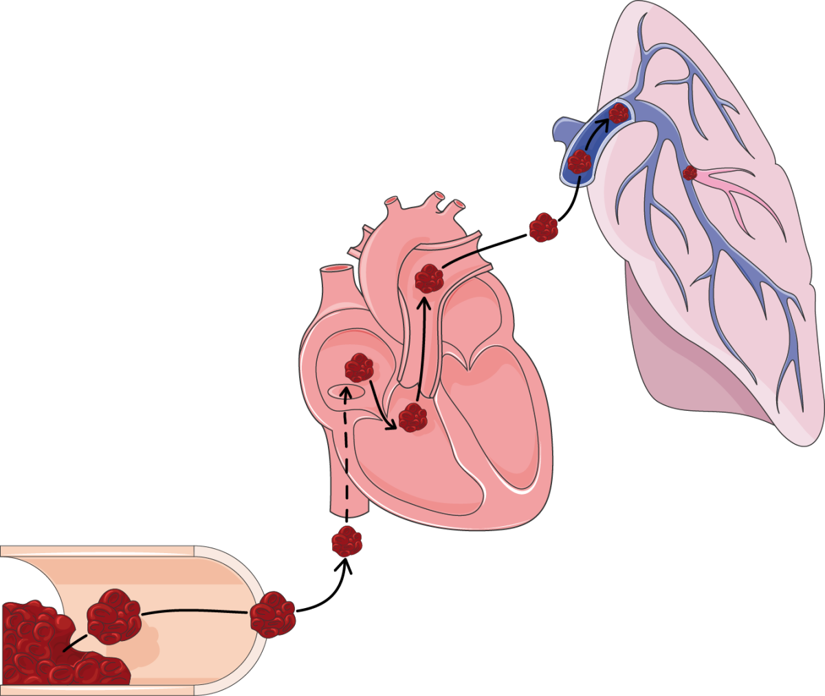 Тромболегочная эмболия