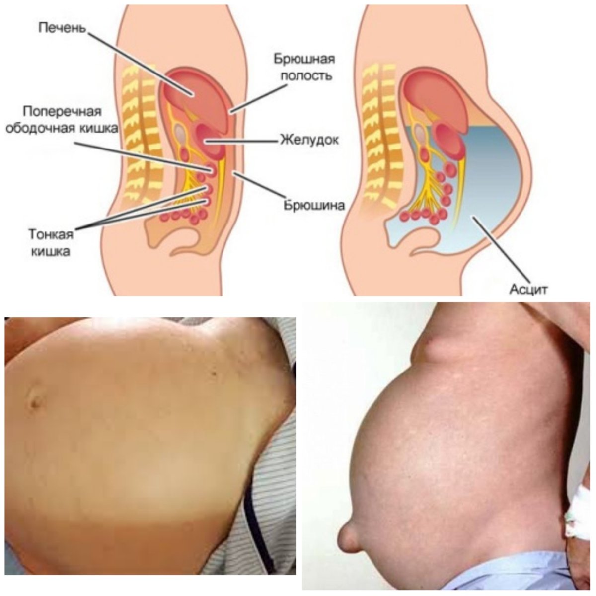 Жидкость в брюшной полости (асцит)