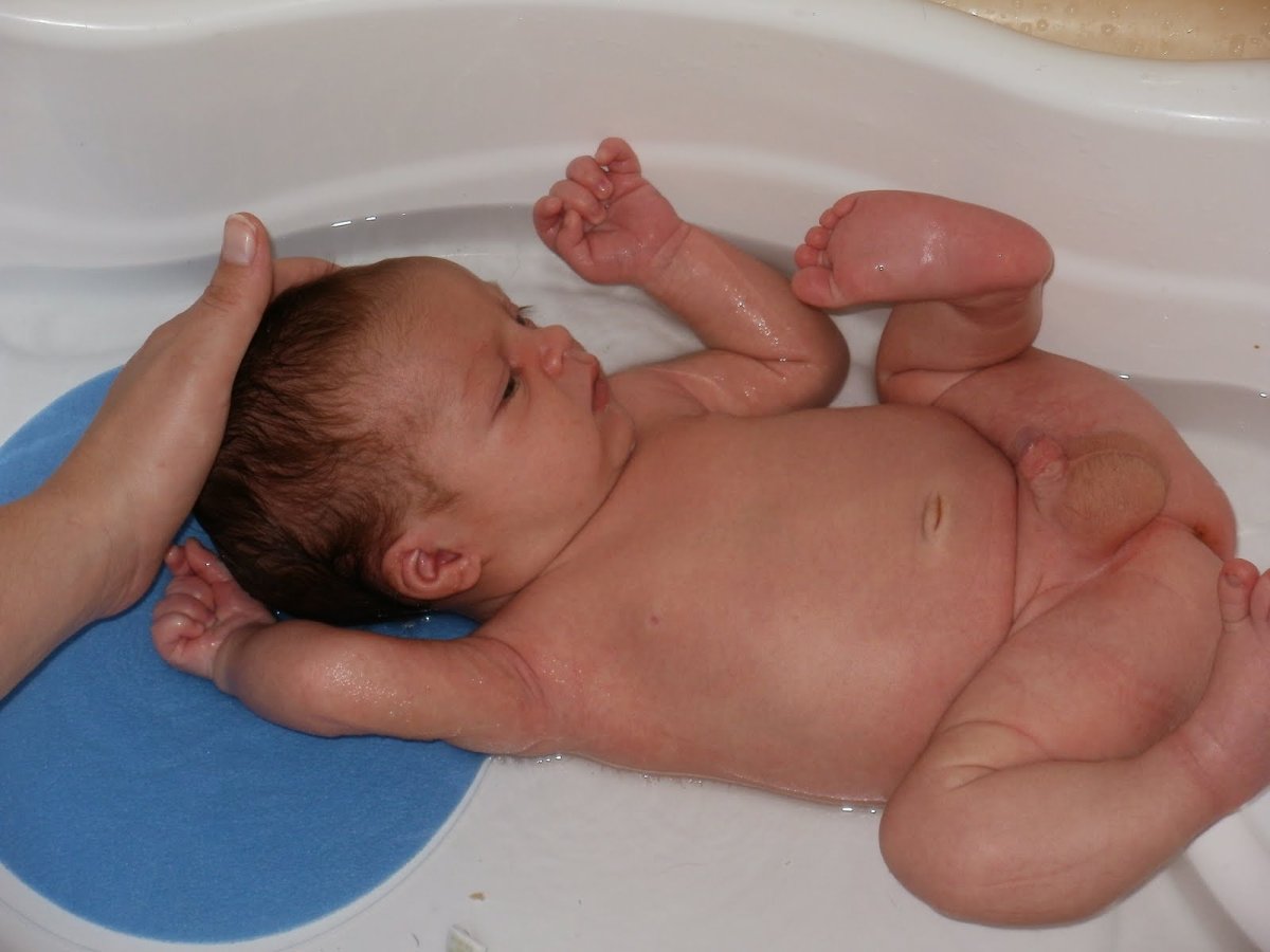 Гидроцеле семенного канатика