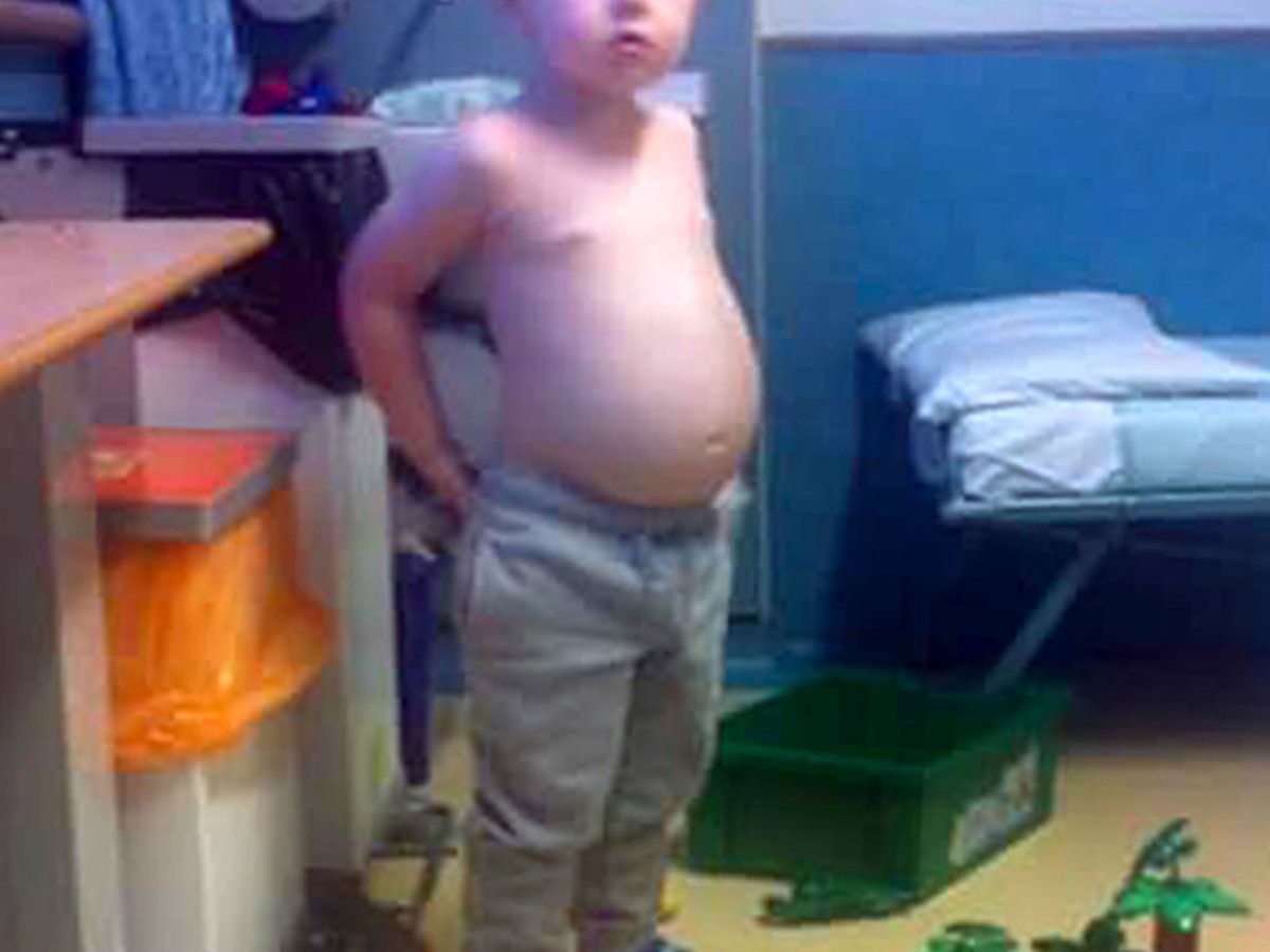 Гидроцефалия головного мозга у ребенка