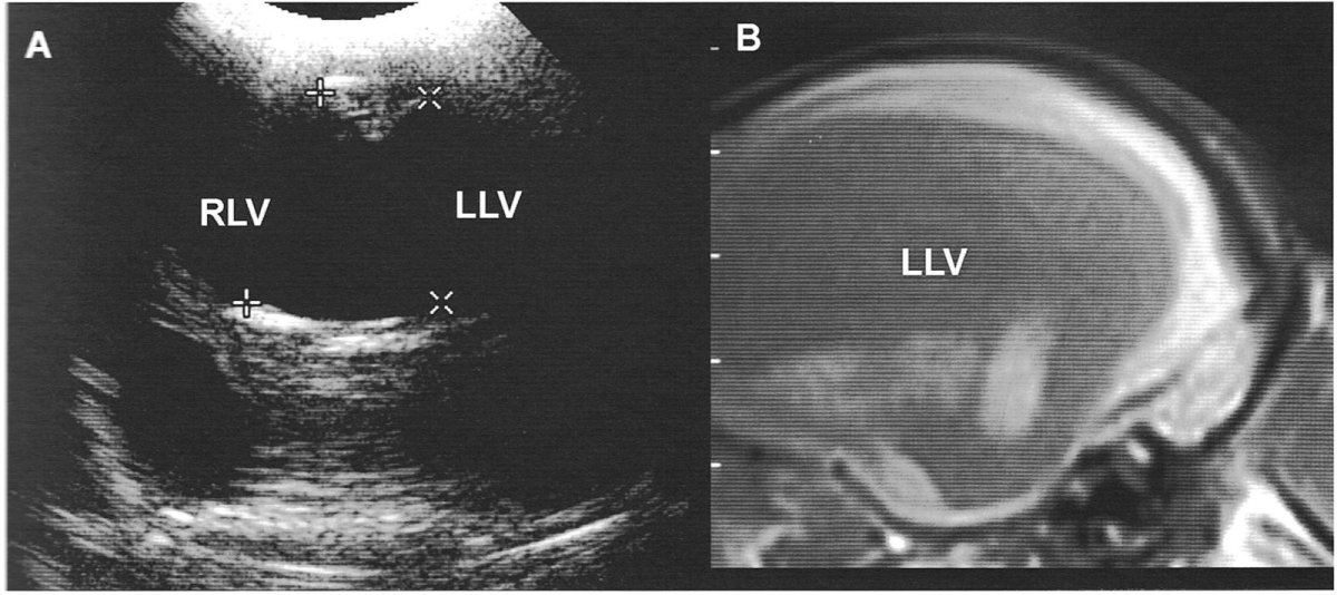 Внутричерепное давление у ребенка 1 год симптомы