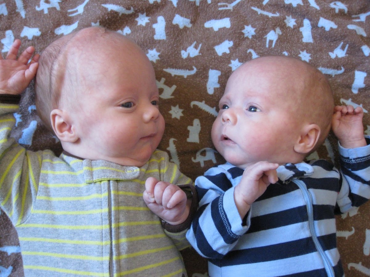 Пупочная грыжа у новорожденных