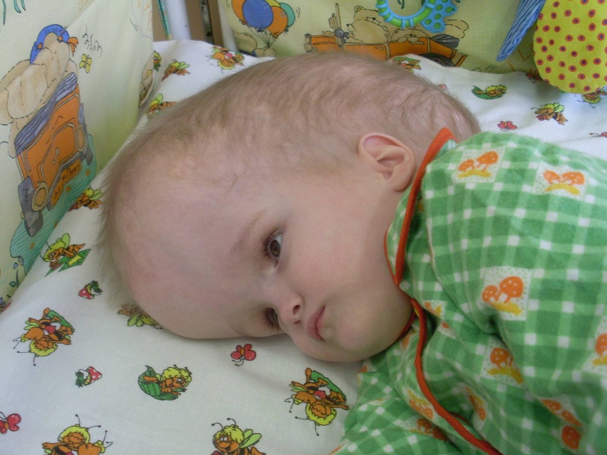 Прогрессирующая гидроцефалия