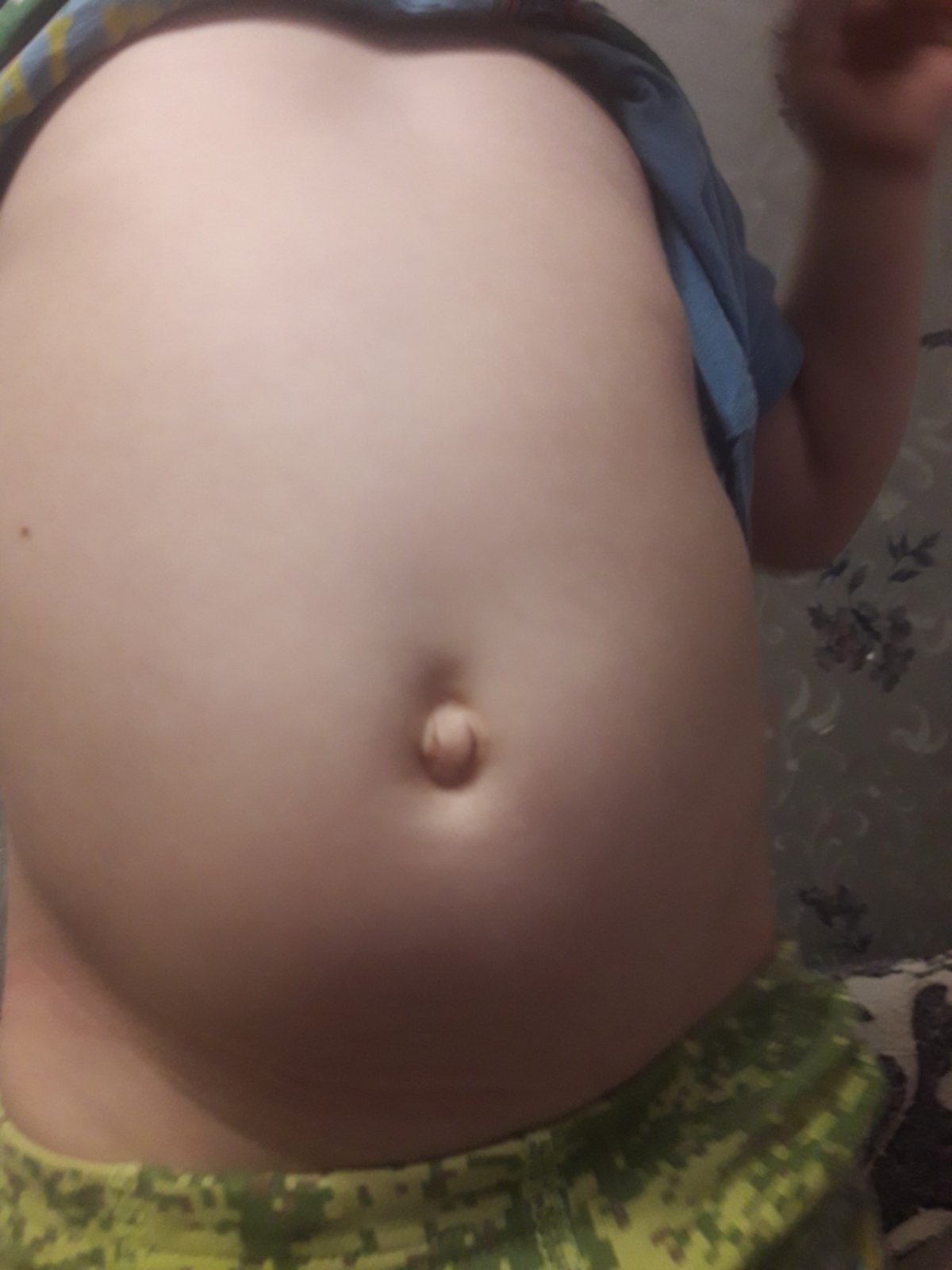 Варикозное расширение вен семенного канатика