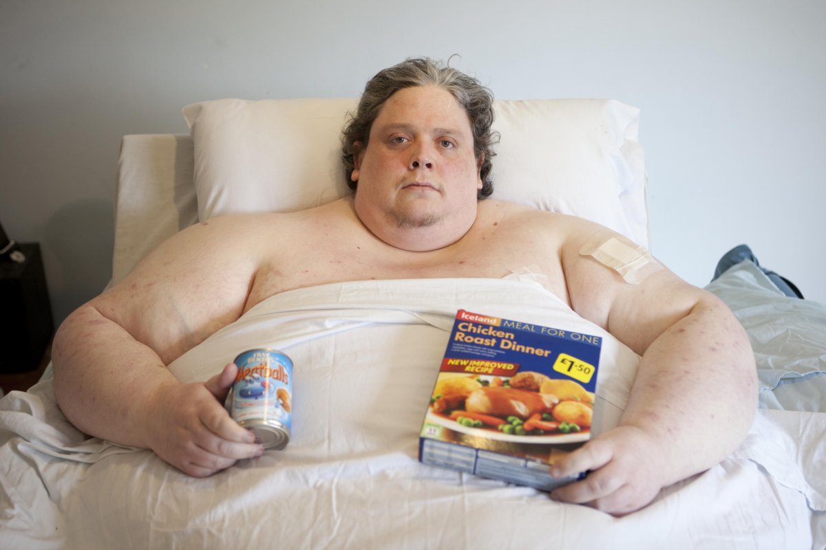 Люди с морбидным ожирением