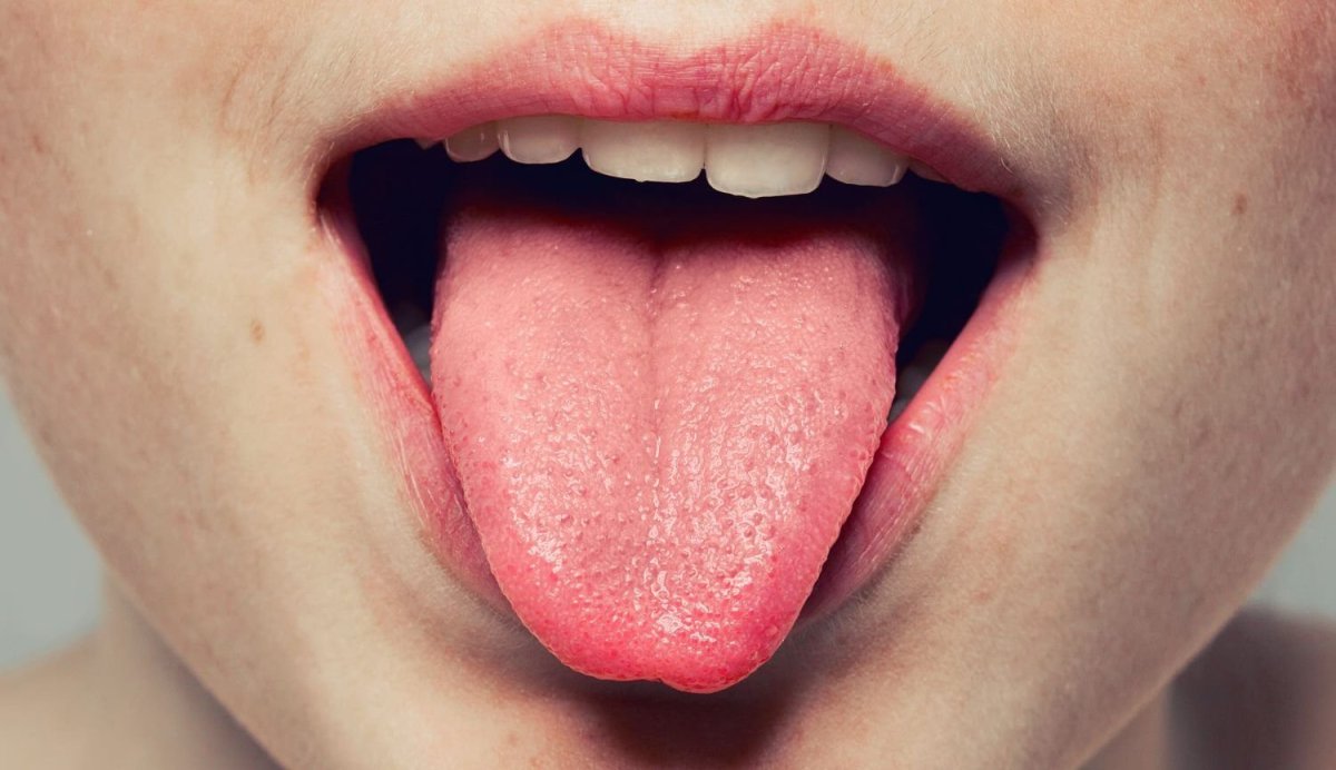 Гипопластический глоссит