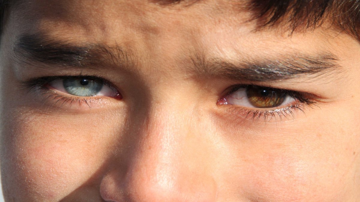 Гетерохромия глаз у людей