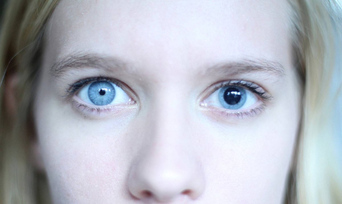 Гетерохромия и анизокория